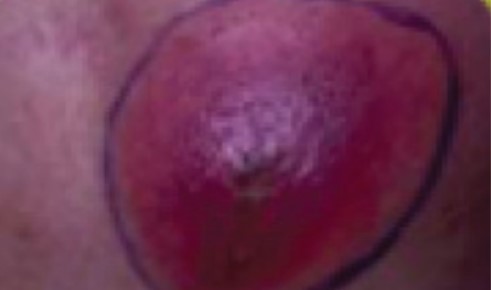 Skin Abscesses